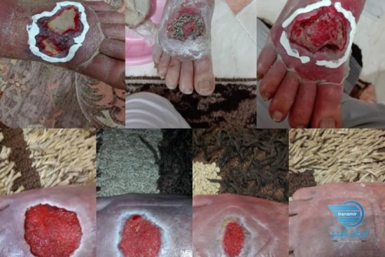 درمان نوین انواع زخمهای دیتبتی،زخم بستر،سوختگی و ....