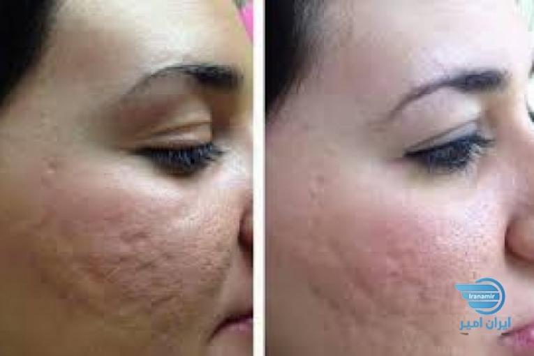 میکروبلیدینگ ابرو ومیکرونیدلینگ پوست