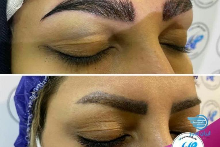 کاشت ابرو مناسب افرادی که ابروهای کم پشتی دارند