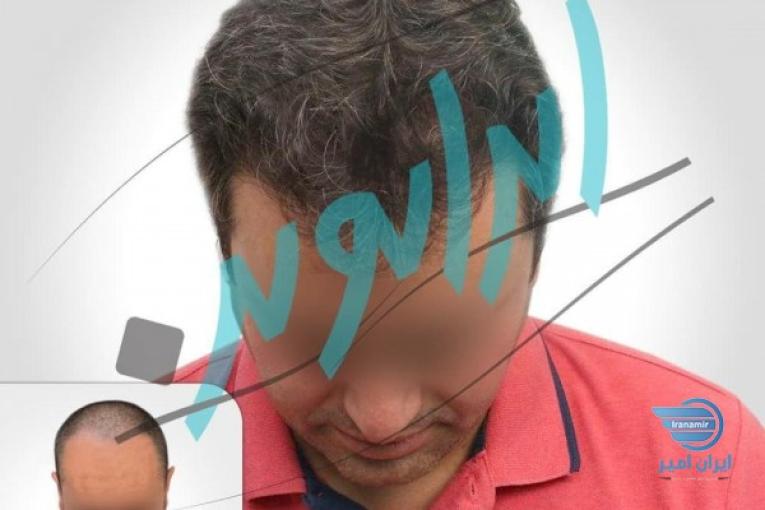 کاشت مو در ایران نوین تنها با دو و نیم میلیون تومان 