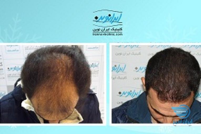 کاشت مو طبیعی با اقساط بلند مدت