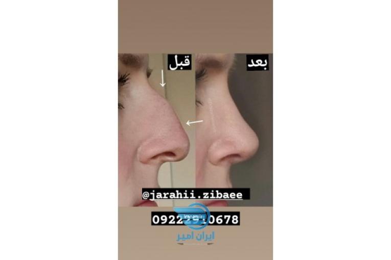 جراحی بینی/پیکرتراشی/لیفت