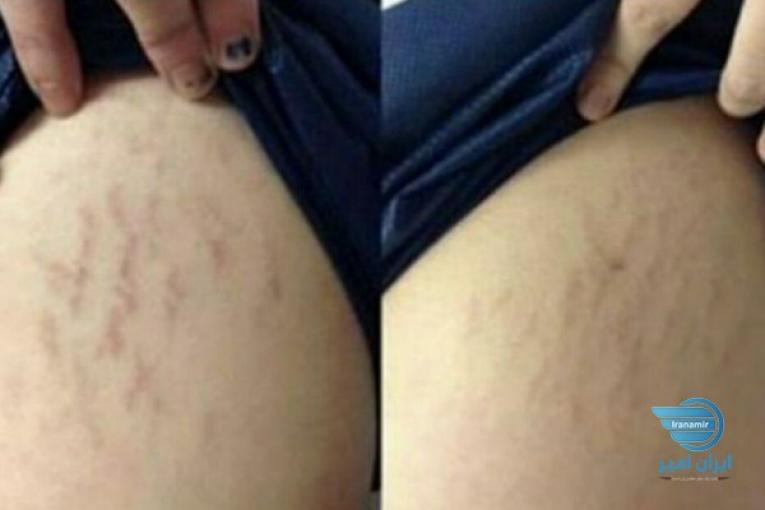 بهبود ترک تیرگی پوست و جوش صورت