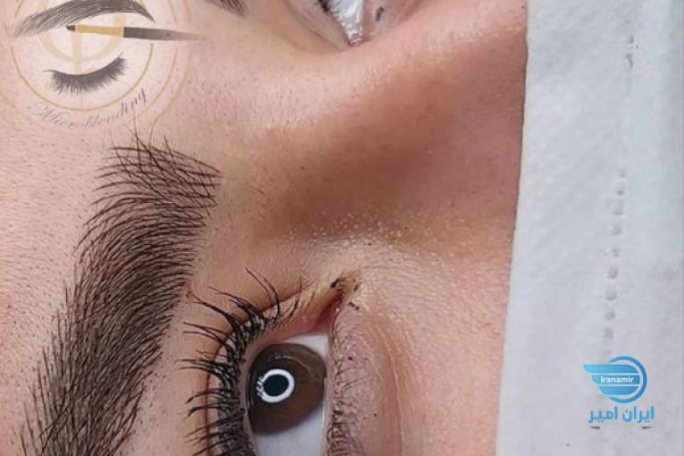 میکروبلیدینگ صورت