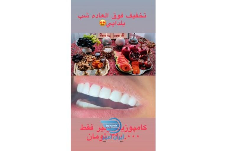 كامپوزيت ونير دندان در مطب دكتر مهسا ذبيحي