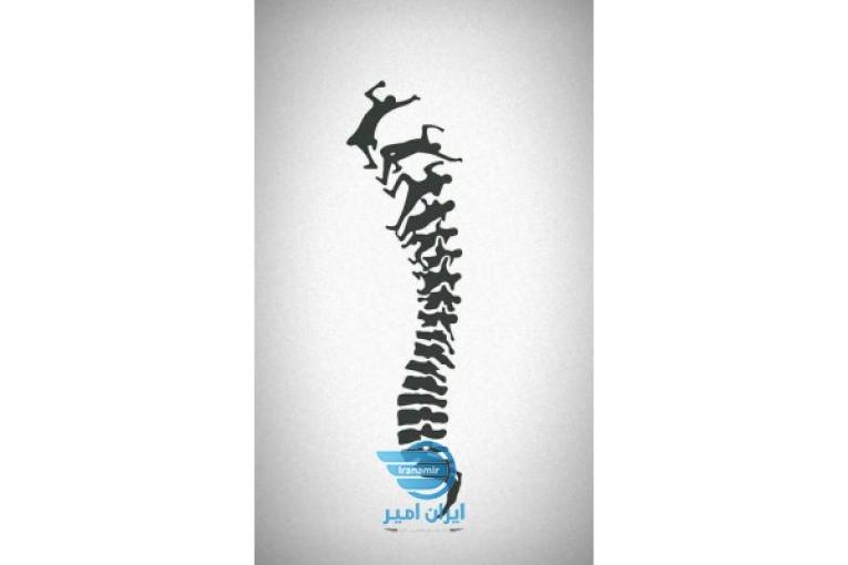 ذرمان قطعی سیاتیک