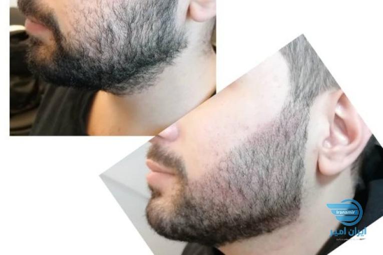 پرپشتی مو در یک جلسه با اسکالپ سر