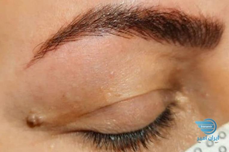 فیبروز ، میکرو بلیدینگ، هاشور، سایه ابرو