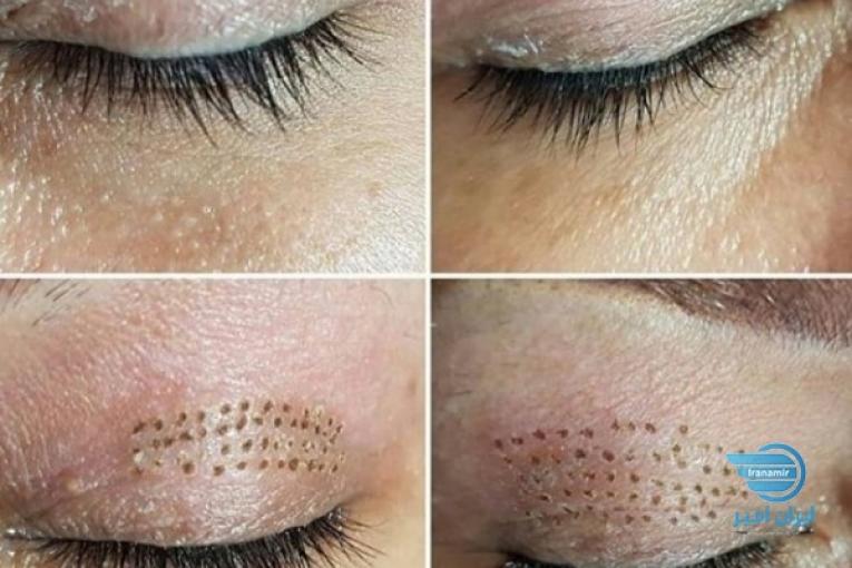 پاکسازی و جوانسازی پوست