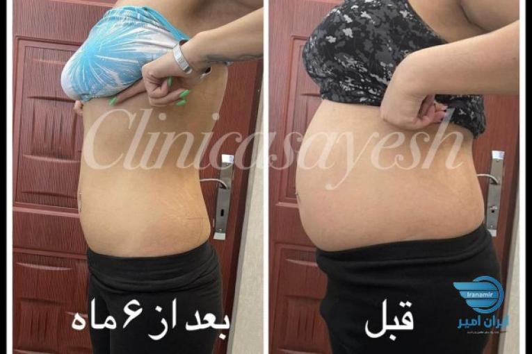 لاغری بدون جراحی با کرایو لیپولیز