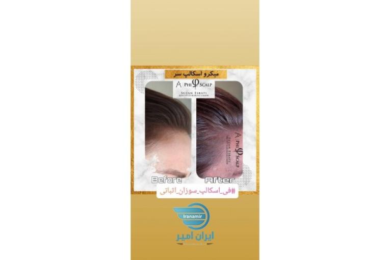 میکرواسکالپ جدید ترین و پر طرفدار ترین