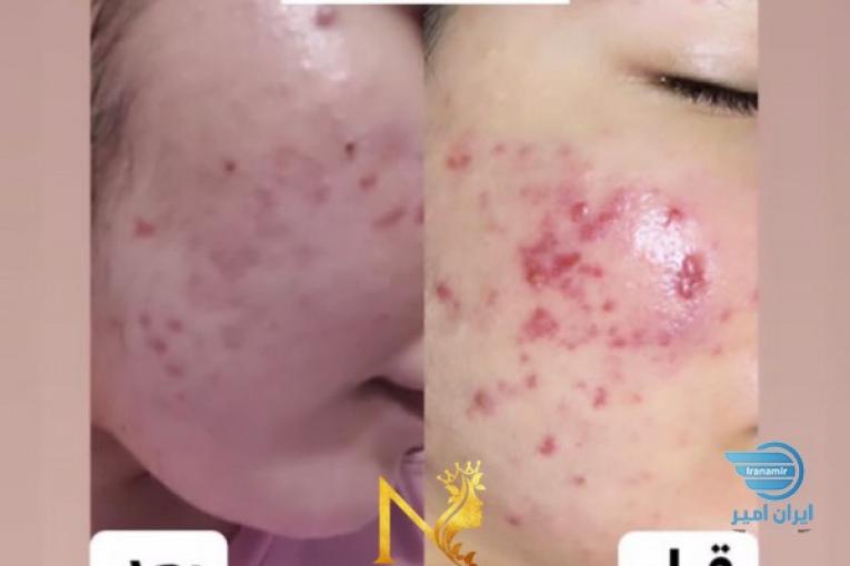 پاکسازی و فیشال تخصصی/مزونیدلینگ/لیزر
