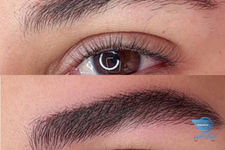 فیبروز و میکروبلیدینگ، میکروپیگمنتیشن 