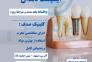 درمان ایمپلنت بدون فشار مالی با اقساط بلند مدت>
