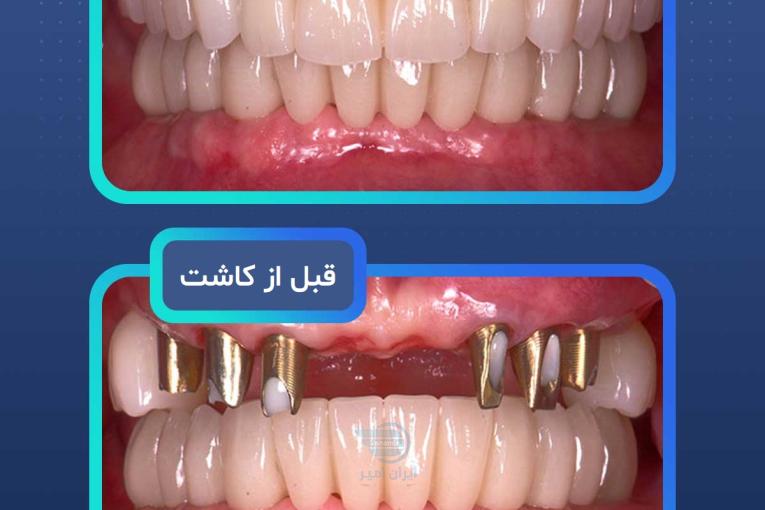 ایمپلنت دندان در مشهد – از دم قسط، بدون سود و بهره!