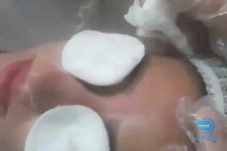 پاکسازی میکرودرم با دستگاه ابریژن ترانس دار
