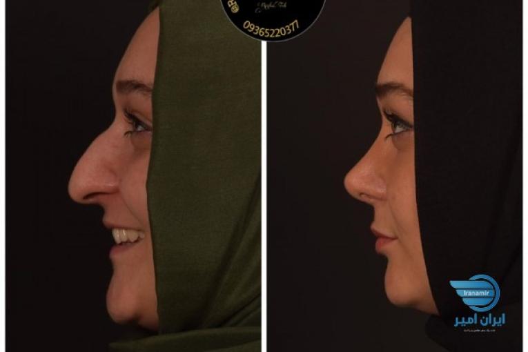 عمل زیبایی بینی با تخفیفات ویژه