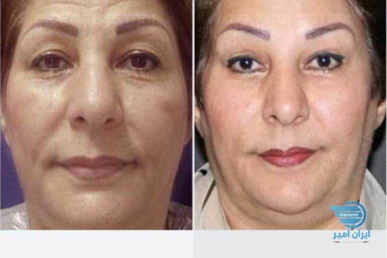جوانسازی و لیفت صورت