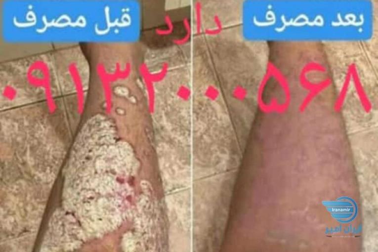 درمان و بهبودی قطعی بیماری پسوریازیس
