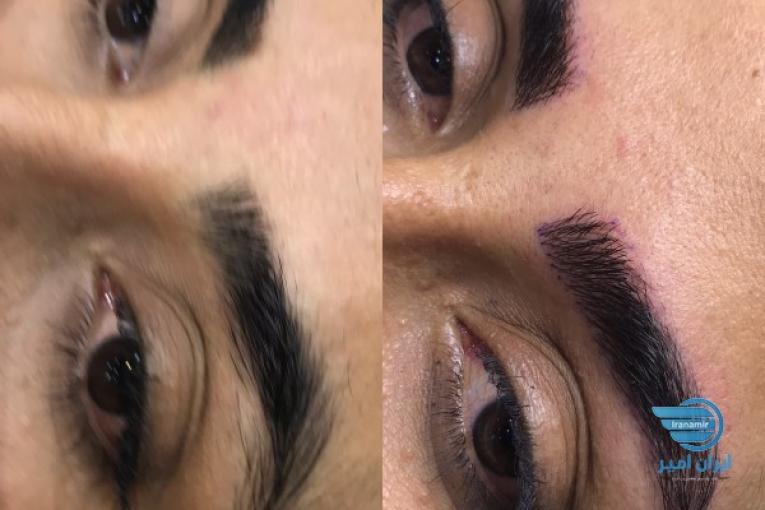 میکروبلیدینگ ابرو به روش فیبرز