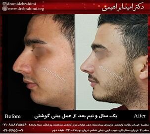جراحی طبیعی بینی