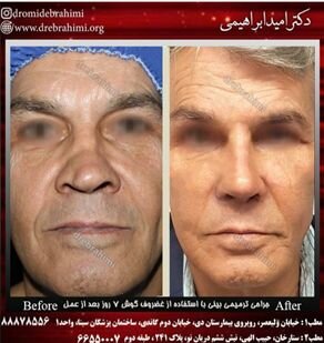 جراحی طبیعی بینی