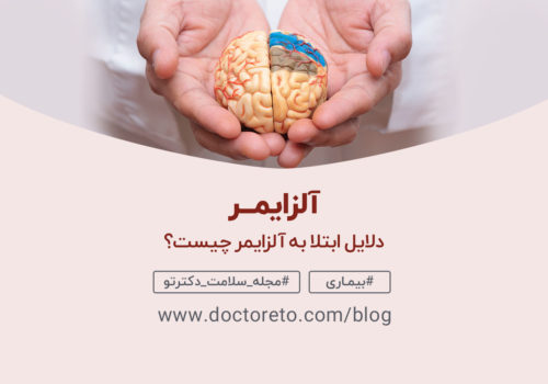 آلزایمر