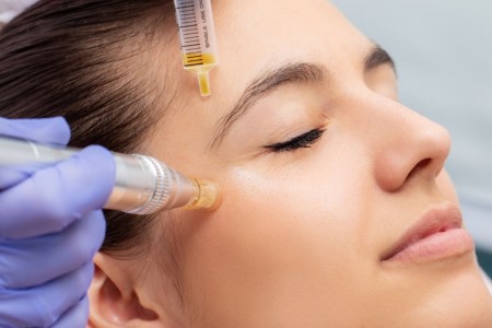 میکرونیدلینگ روشی برای جوانسازی پوست